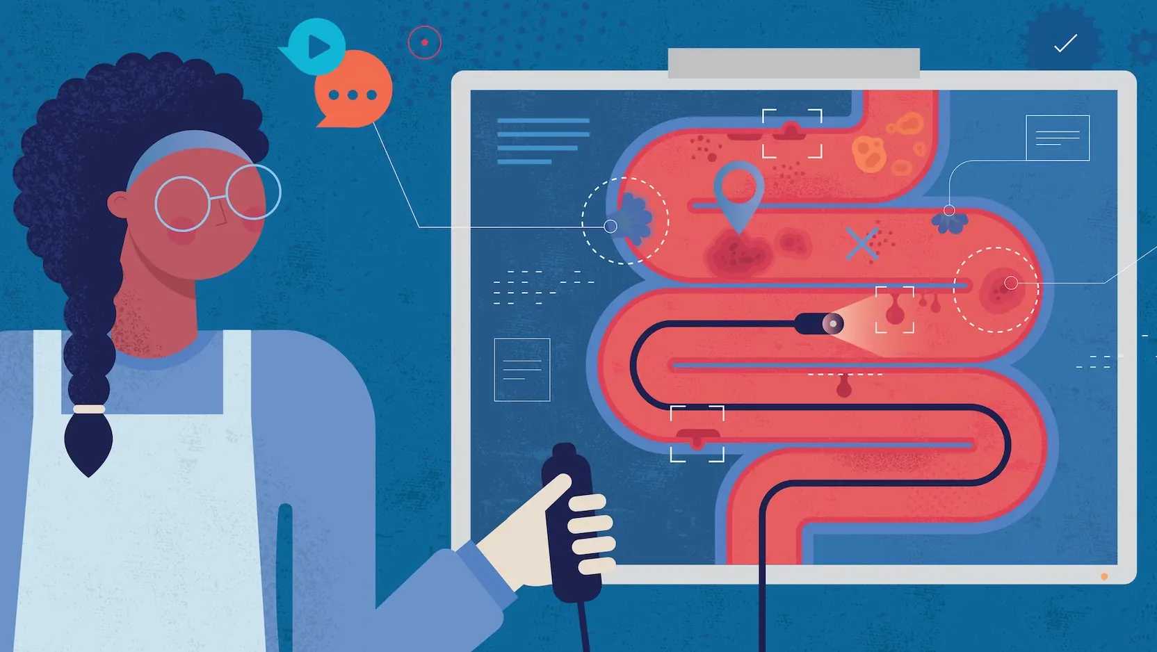 colonscopy illustration