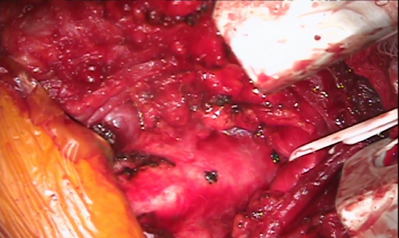 Photo of tracheal stenosis
