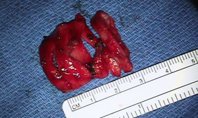 Tracheal rings removed during surgery