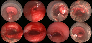 Pre-op photo before a tracheal resection and reconstruction