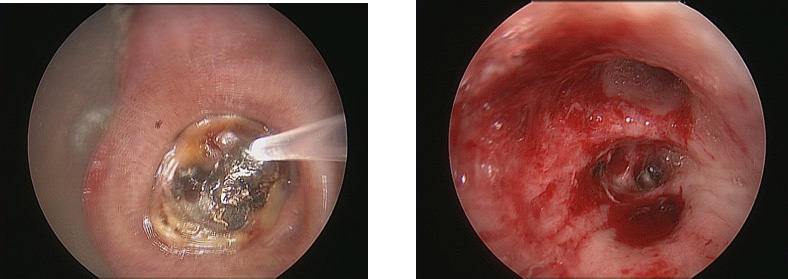 Laser treatment of airway tumor
