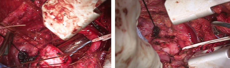 Reconstructing the airway back together