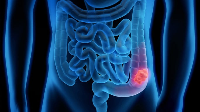 Colorectal cancer illustration