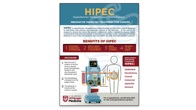 HIPEC Infographic