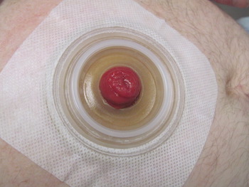 Stoma Bleeding and Irritation  Ostomy Bag Leaking - UChicago Medicine