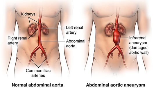 abdominal aortic aneurysm