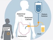 Kidney Dialysis Treatment UChicago Medicine Kidney Dialysis Treatment UChicago Medicine