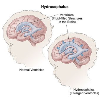 hydrocephalus diagram