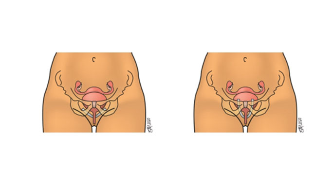 Illustration of midurethral sling