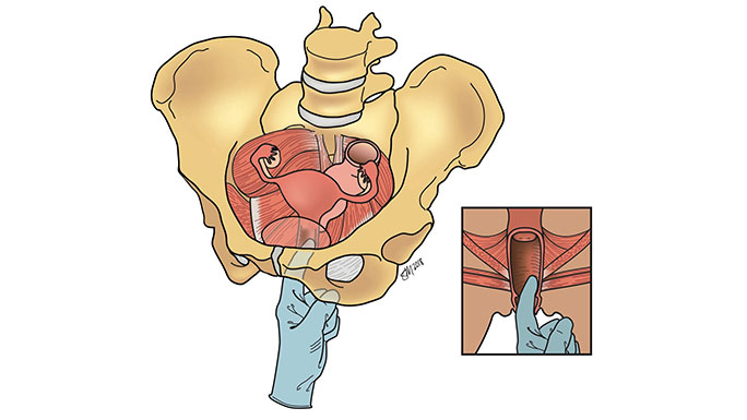 Electrical Stimulation For The Pelvic Floor - Incontinence & Prolapse