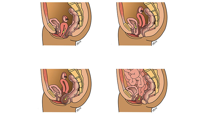 Medical Illustration Showing Difference Normal Uterus Prolapsed