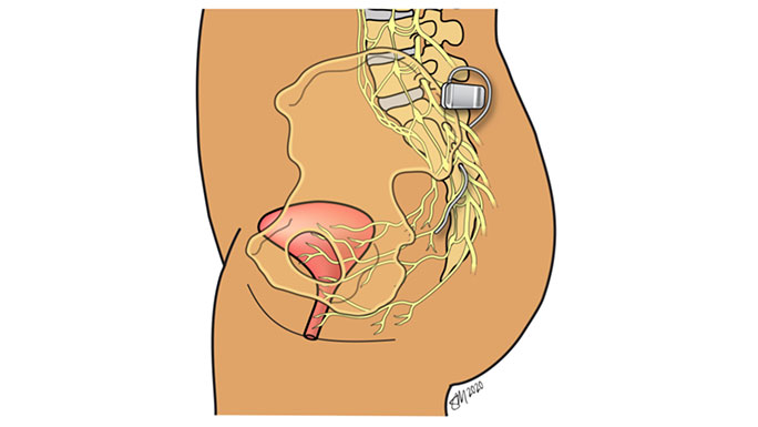 Sacral neuromodulation (SNM)