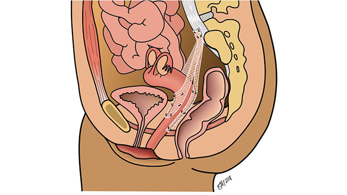 Sacrocolpopexy illustration