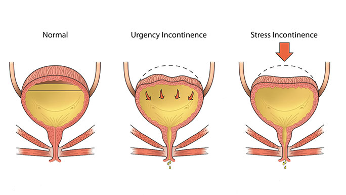 Urinary Incontinence - UChicago Medicine