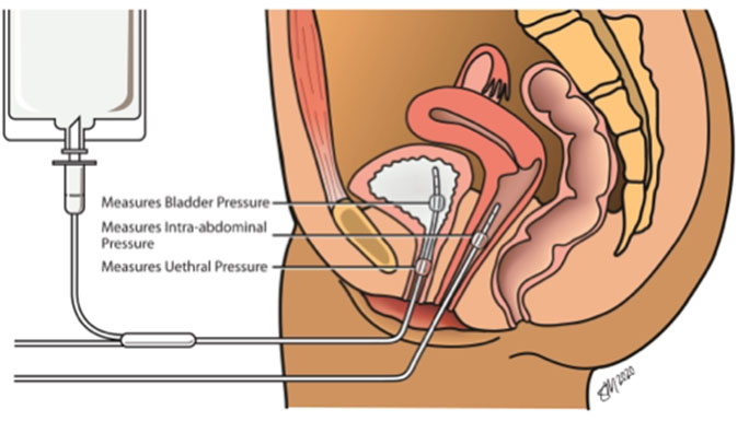 Illustration of urodynamic testing