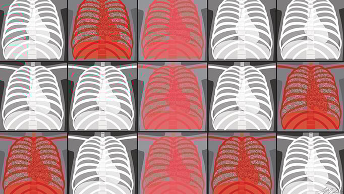Lung x-ray graphic