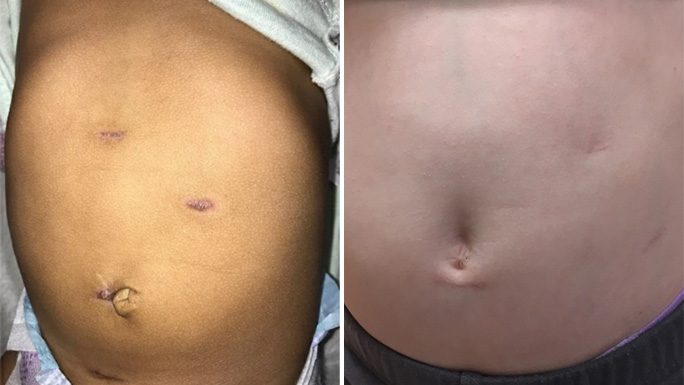 Image of pediatric urology surgery incisions over time