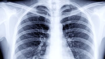 X-ray of chest