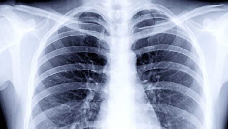 X-ray of chest