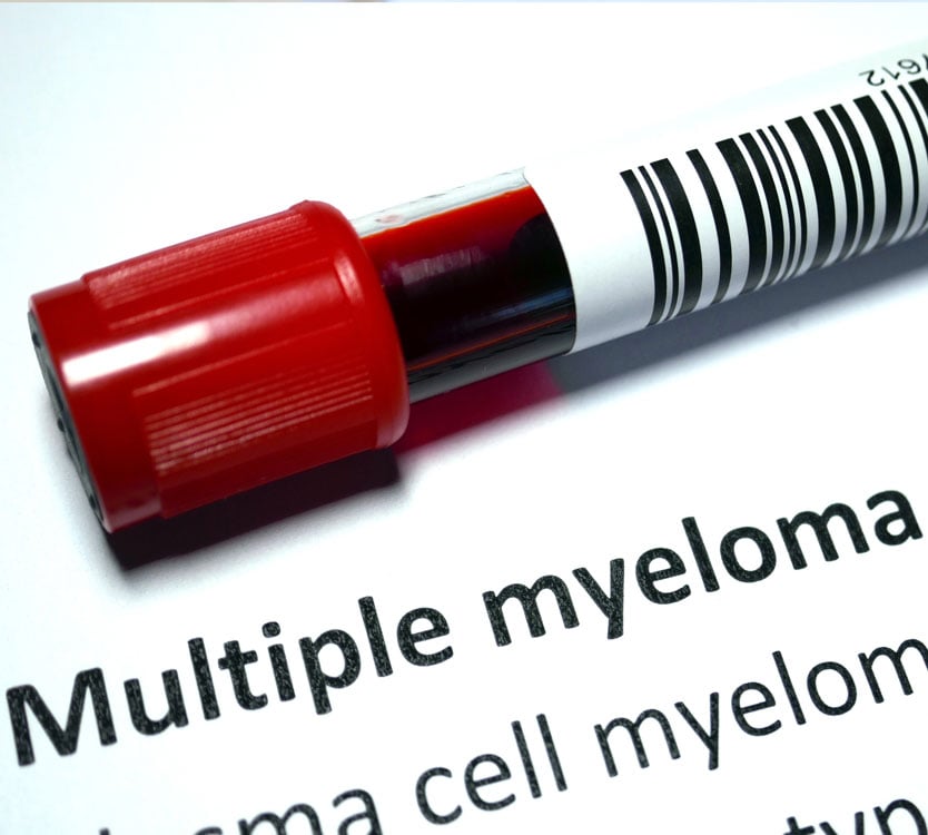 multiple myeloma stock
