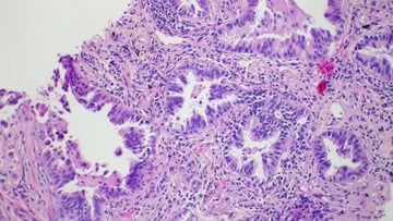 Adenocarcinoma arising in bronchiolar metaplasia. Case 274