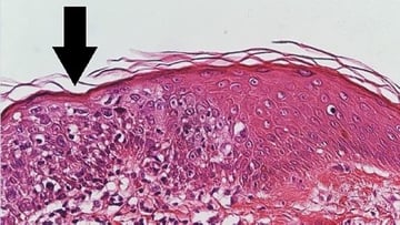Histopathology of squamous cell carcinoma in situ