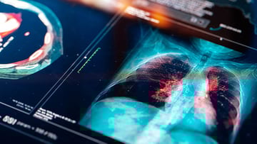 A digital MRI scan showing lungs. A new study supports saving more lung tissue in lung cancer surgeries.