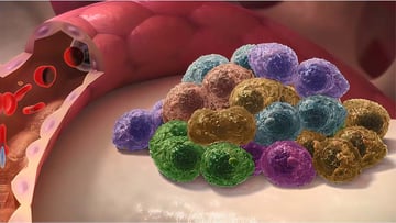 A 3D illustration of multiple myeloma, a type of cancer.