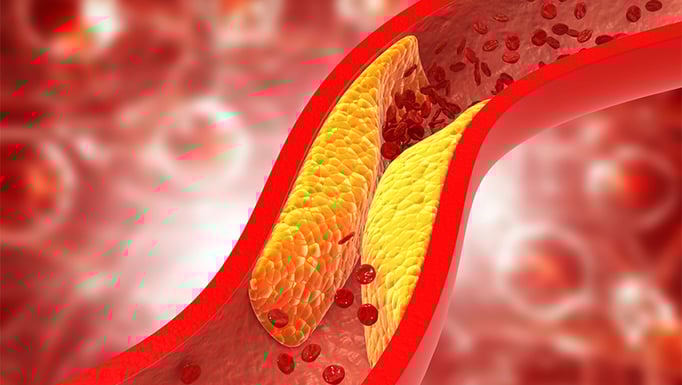 Peripheral Artery Disease