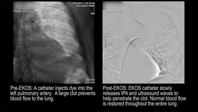 pulmonary artery for sciencelife