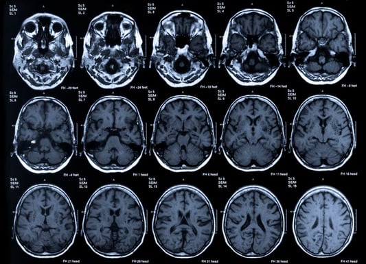MRI scan of a human head.