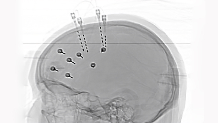 Image of a brain scan with seizure mapping