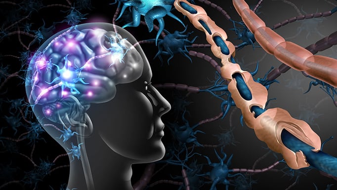 Multiple sclerosis nerve disorder and damaged myelin or MS autoimmune disease with healthy nerve with exposed fibre with scarrred cell sheath loss with 3D illustration elements.