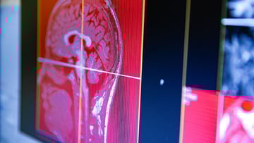 Magnetic Resonance Head Scan Images on Computer Monitor While Scanning.