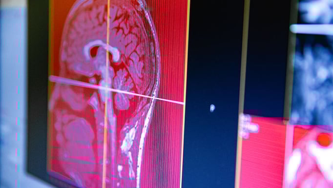 Magnetic Resonance Head Scan Images on Computer Monitor While Scanning.