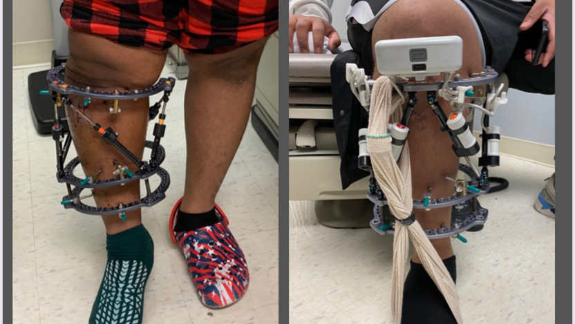 Groundbreaking new device helps correct Chicago man's severe bow legs -  UChicago Medicine