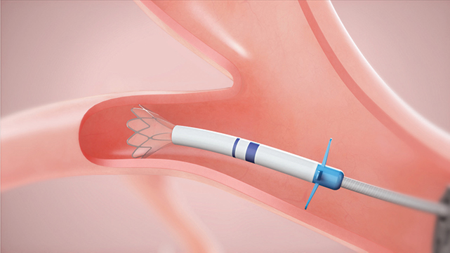 Zephyr lung valve, courtesy of Pulmonx Corp.