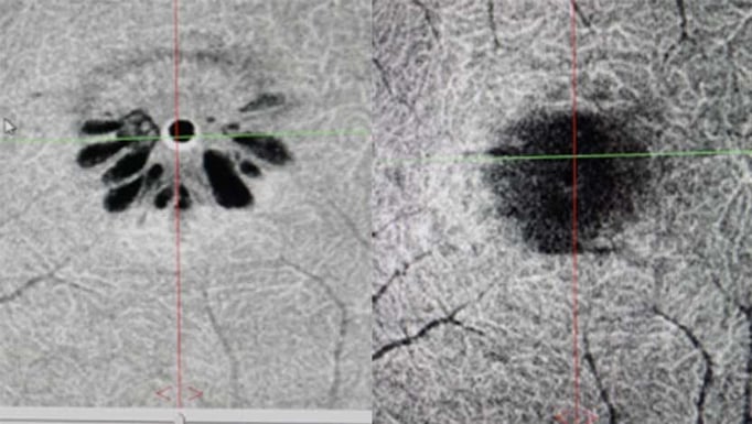 Experimental Treatment For Macular Holes Opts For Eye Drops Over