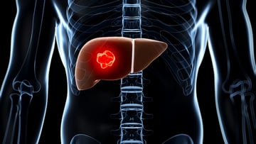 Illustration of liver cancer