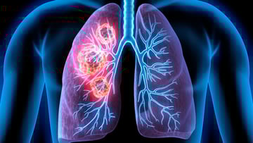 Depiction of cancerous areas in lungs