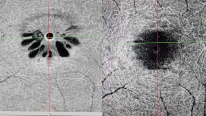 macular hole