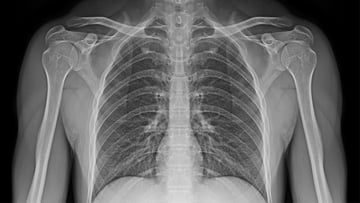 Image of X-ray