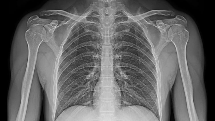Image of X-ray