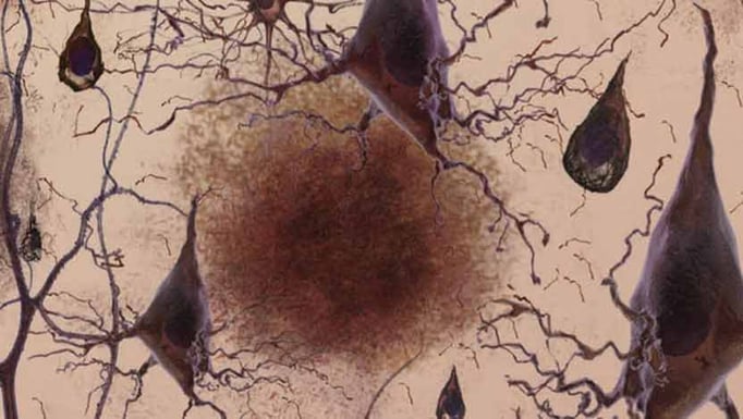 Alzheimer
