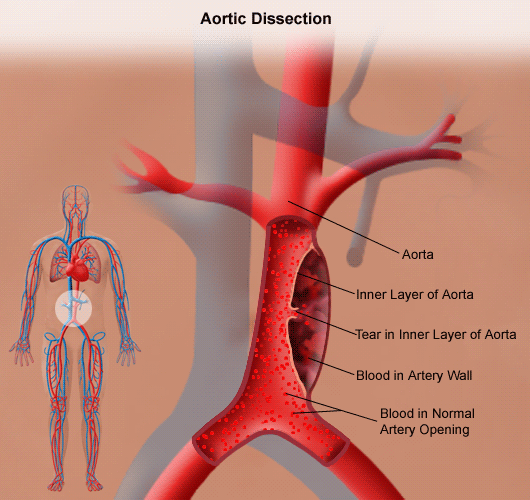 aortic dissection