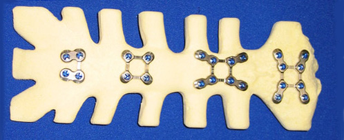 sternal plating
