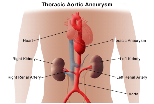 Thoracic Aortic Aneurysm Uchicago Medicine