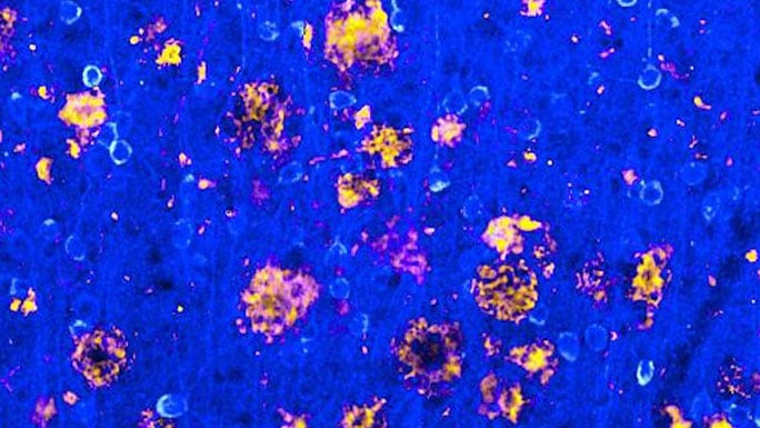 Amyloid deposits