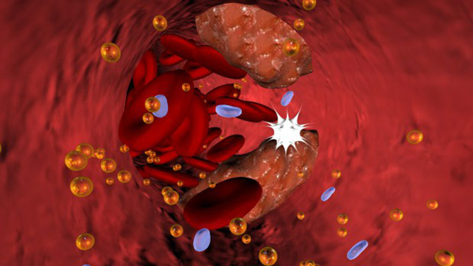 Atherosclerosis
