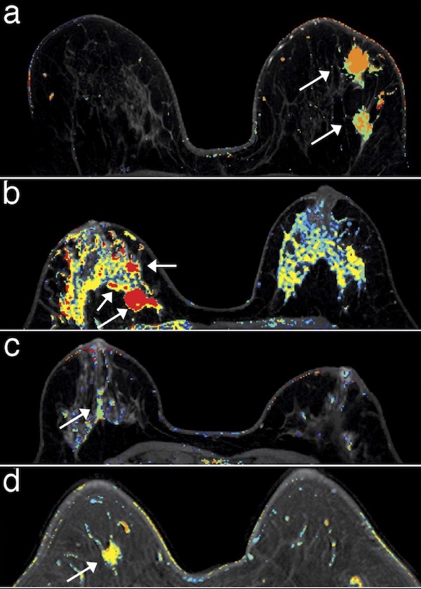 Breast MRI image